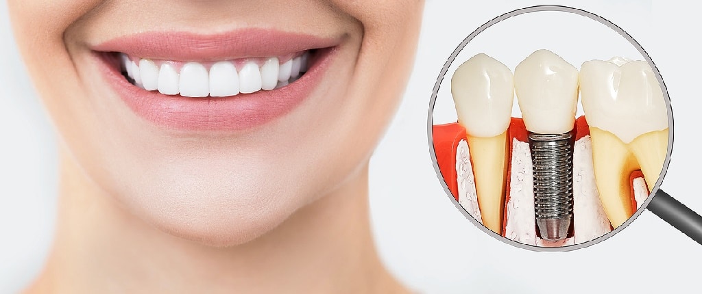 Why are dental implants needed?