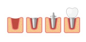 Why No Dairy After Dental Implant  