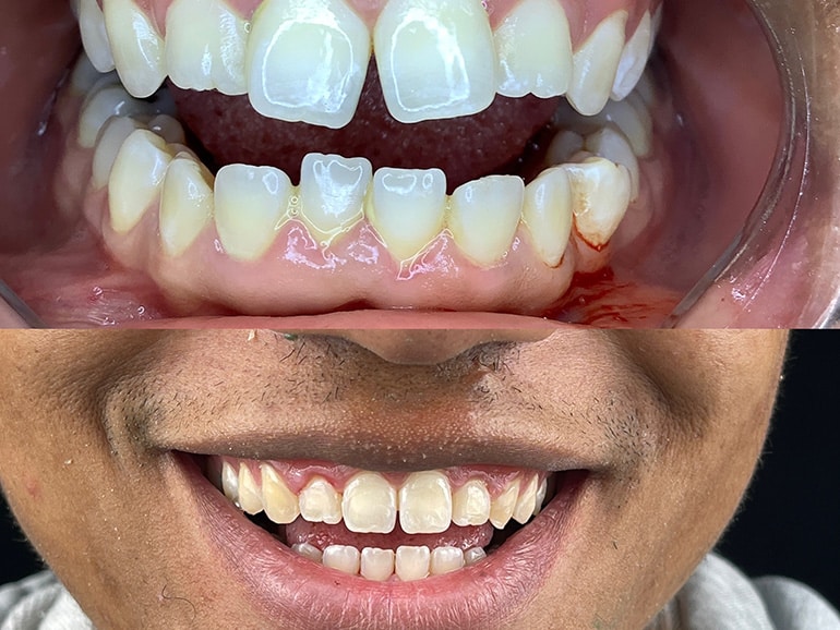 Patient that has Invisalign in Woodland Hills