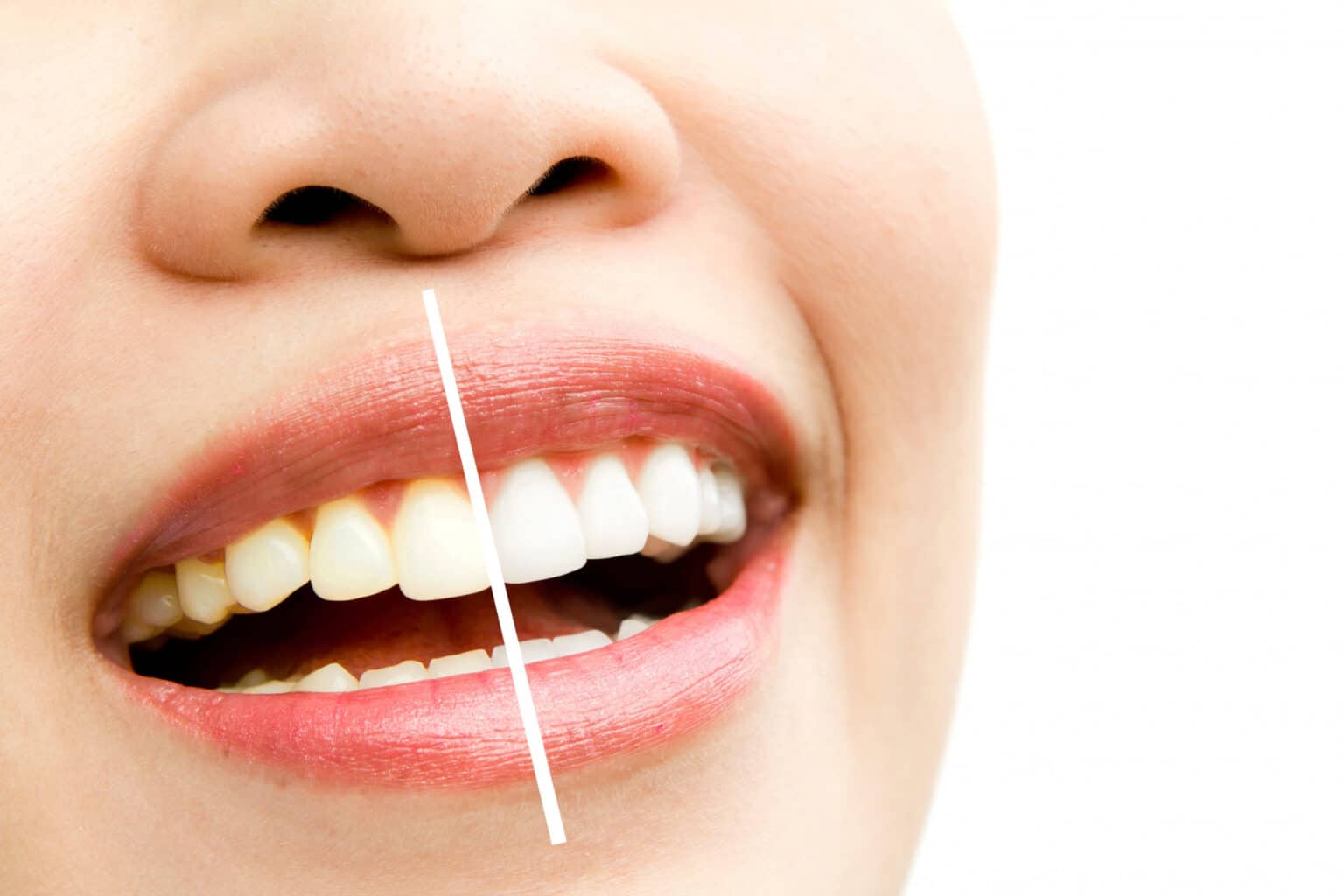 5 Cosmetic Dental Procedures What Are Their Benefits 