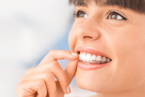 Invisalign in woodland hills