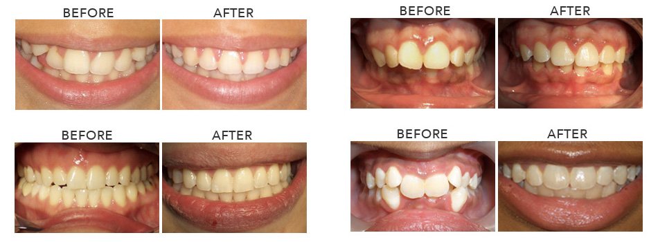 Popular Teeth-Straightening Options in Woodland Hills