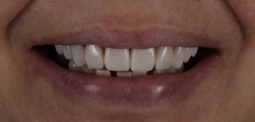 Post-Veneers