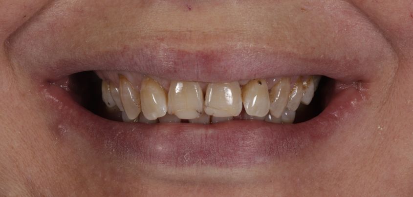 Pre-Veneers