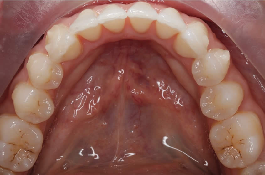 case-straightening2-after-b