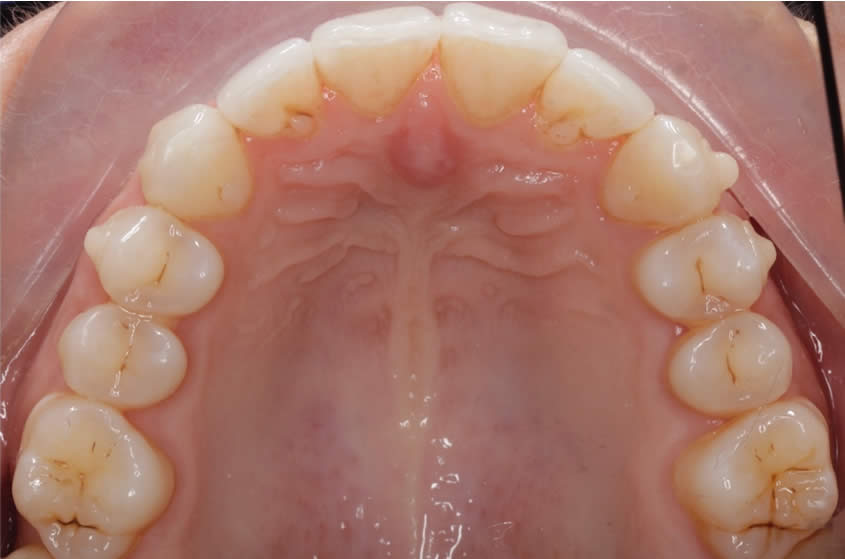 case-straightening2-after-c