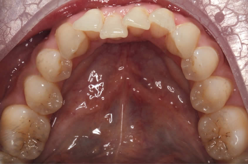 case-straightening2-before-b