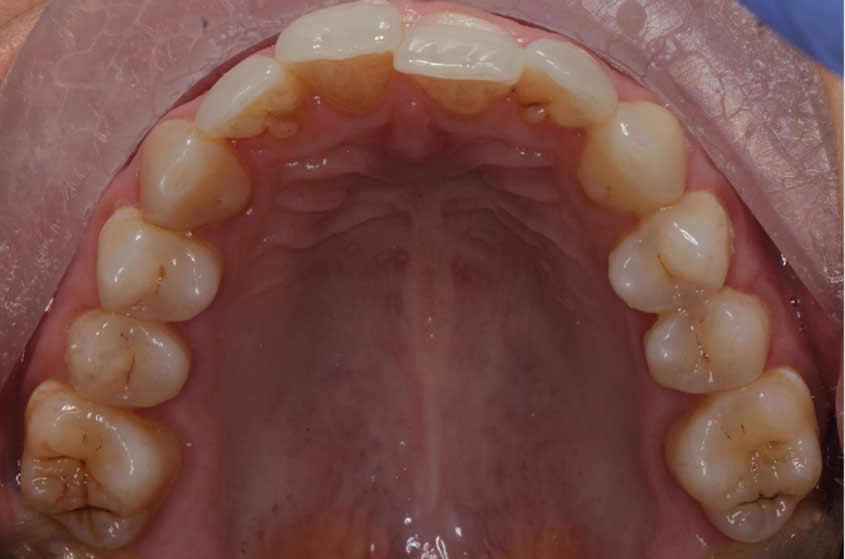 case-straightening2-before-c