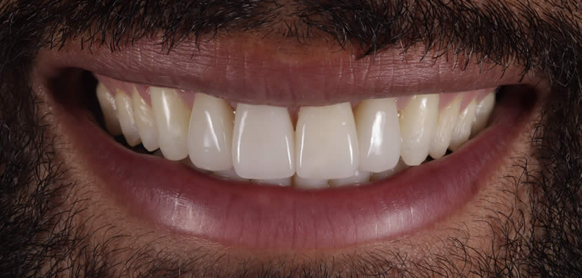 case-veneers1-after