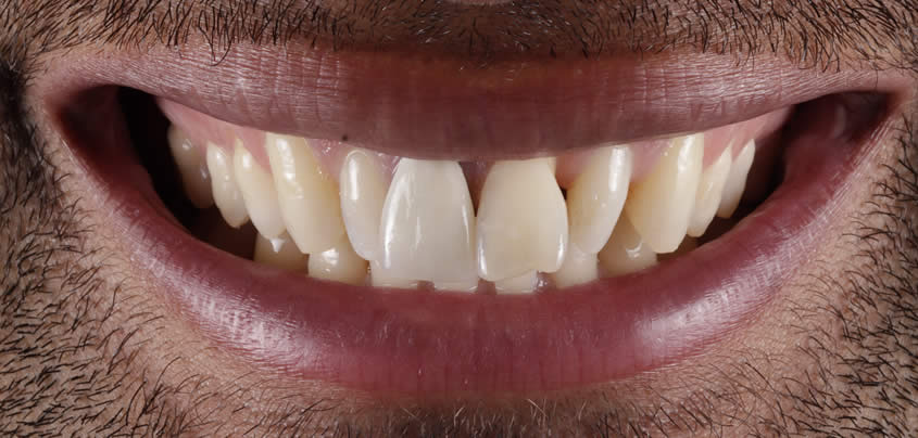 case-veneers1-before