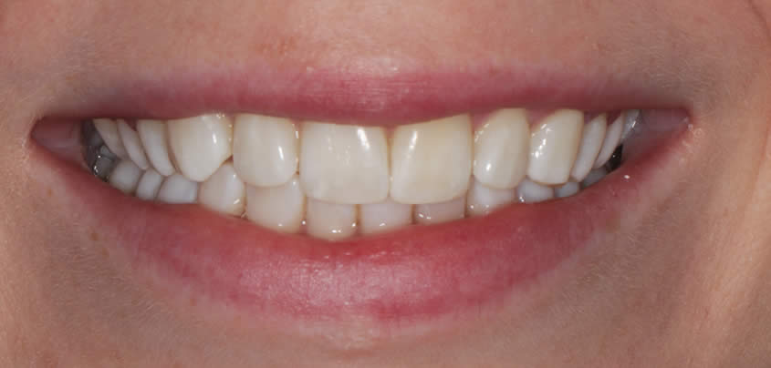 case-whitening1-after