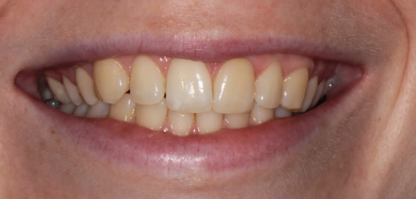 case-whitening1-before
