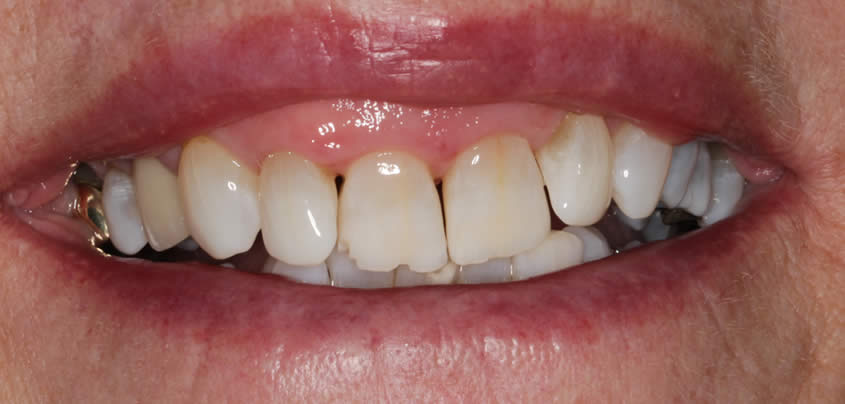 case-whitening2-after