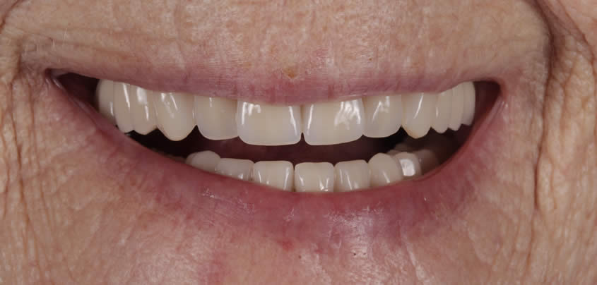 dentures-1-after