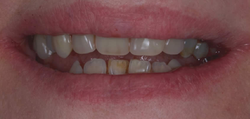 dentures-2-after