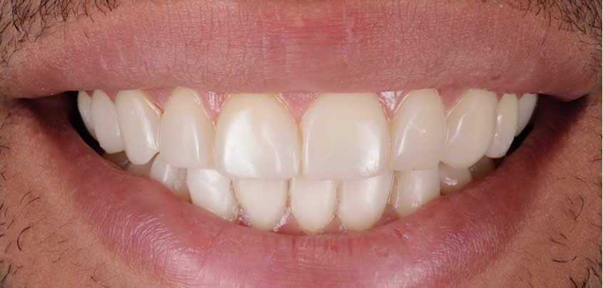 smile-makeover1-after-a2