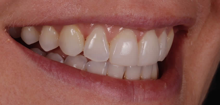smile-makeover2-after-b-1