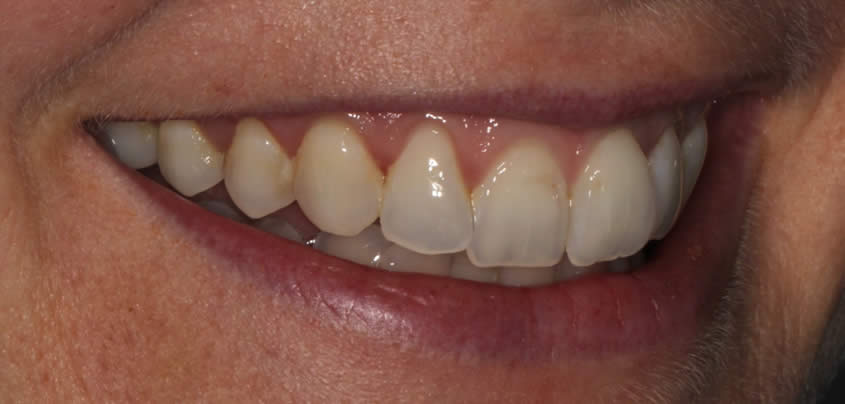 smile-makeover2-before-a
