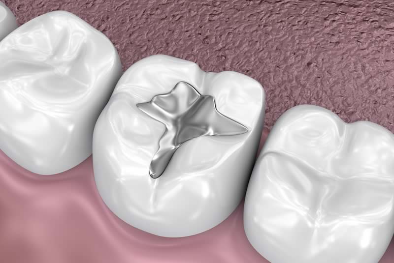 dental fillings in woodland hills