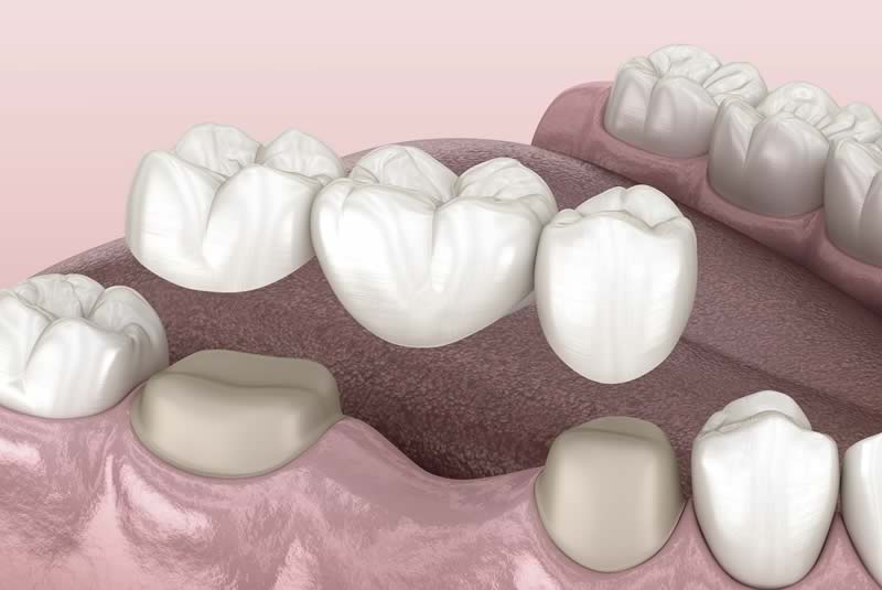 dental bridges in woodland hills