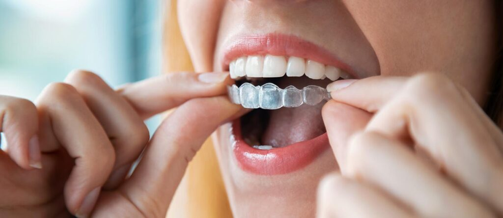 Teeth Straightening in Woodland Hills