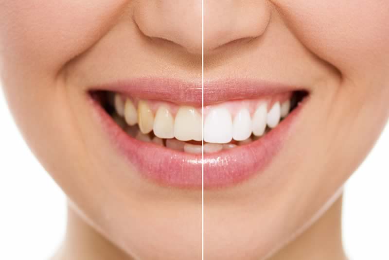 Teeth Whitening woodland hills 